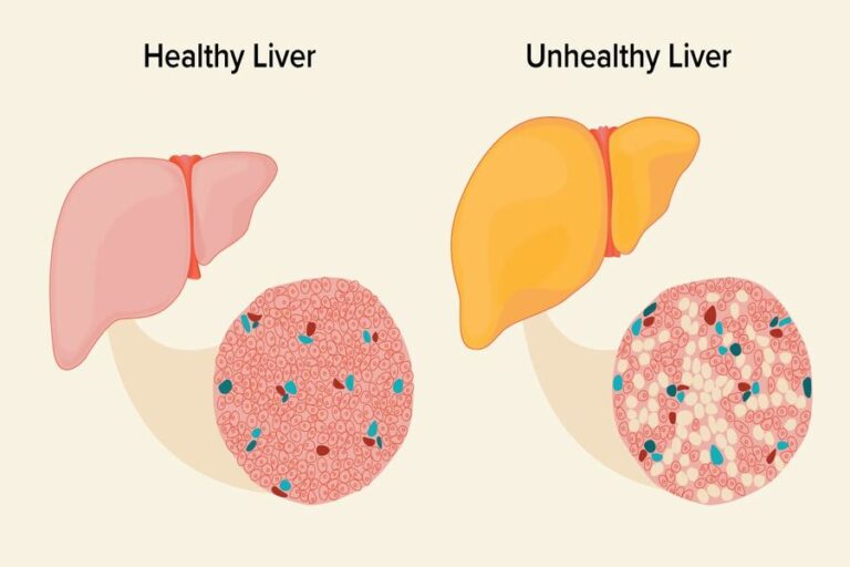 Foods That You Must Avoid During Your Fatty Liver