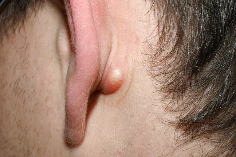 A Handy Guide To Understanding And Treating Earlobe Cyst