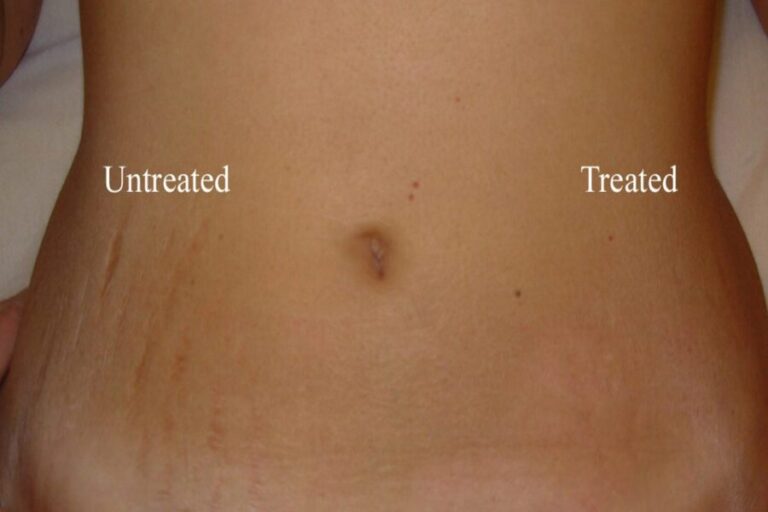 Get Your Confidence Back With Stretch Marks Removal Remedies 
