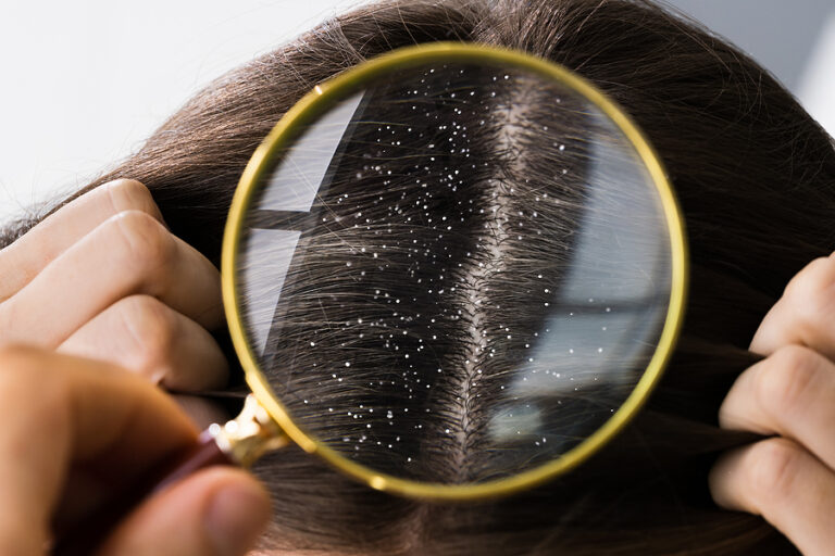 All about dandruff and its treatment