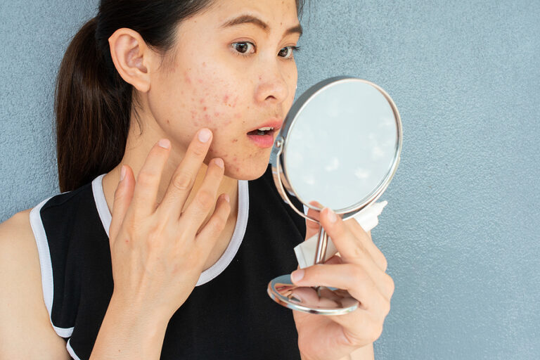 What are acne, its causes, and treatment?