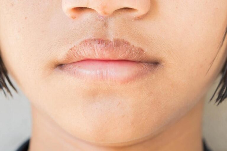 Essential Tips to get rid of Dry Lips