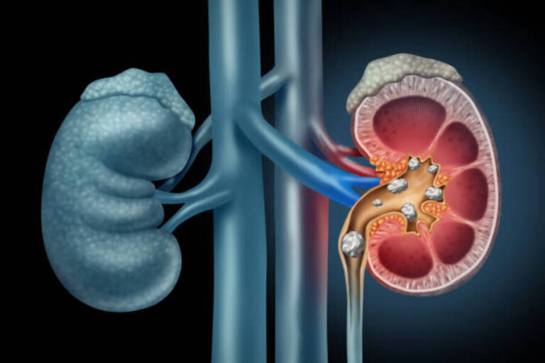 Understanding Kidney Stones: Causes, Symptoms, and Treatment