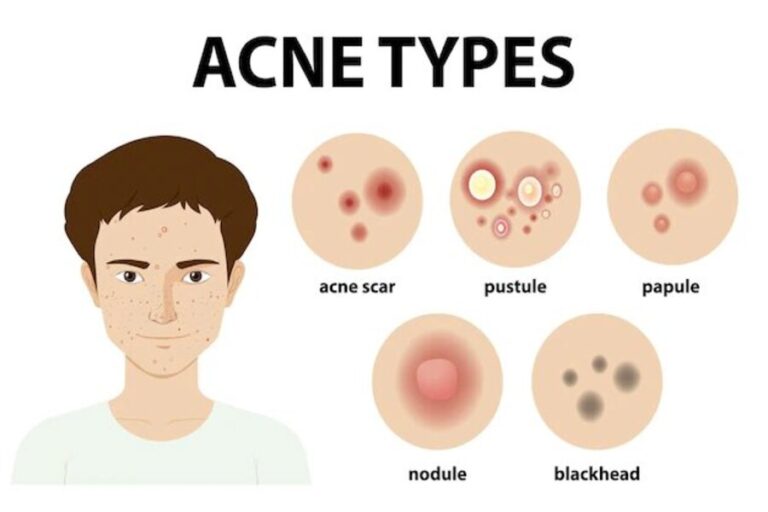 Essential Foods to Prevent Acne